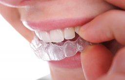 Niềng răng ecligner là gì và niềng răng ecligner giá bao nhiêu?