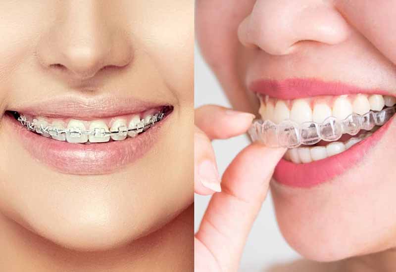 Lựa chọn loại mắc cài phù hợp với tình trạng răng miệng