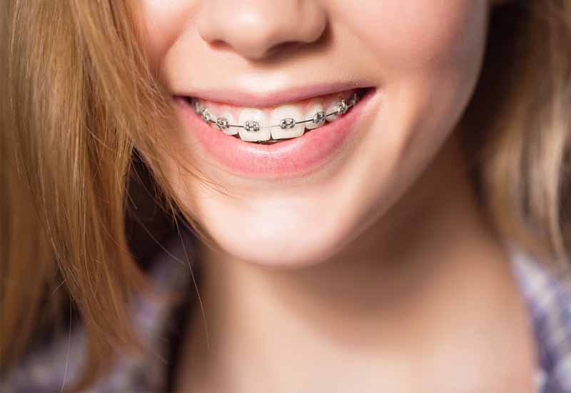 Niềng răng mắc cài truyền thống là phương pháp chỉnh nha phổ biến hiện nay