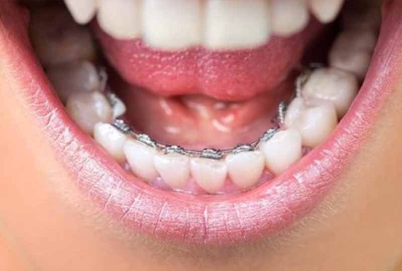 Chi phí niềng răng 1 hàm ảnh hưởng bởi nhiều yếu tố