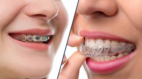 Phương pháp niềng răng là yếu tố hàng đầu ảnh hưởng đến giá niềng răng