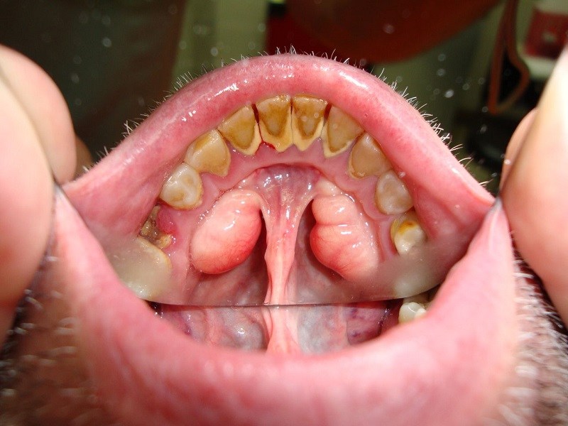 Cao răng tích tụ khiến miệng hôi thối