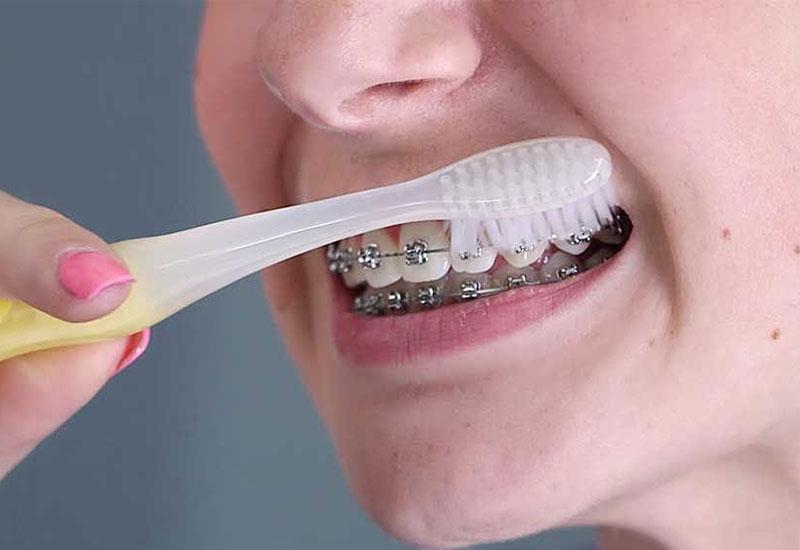 Sử dụng mắc cài tự đóng giúp vệ sinh răng miệng tiện lợi hơn