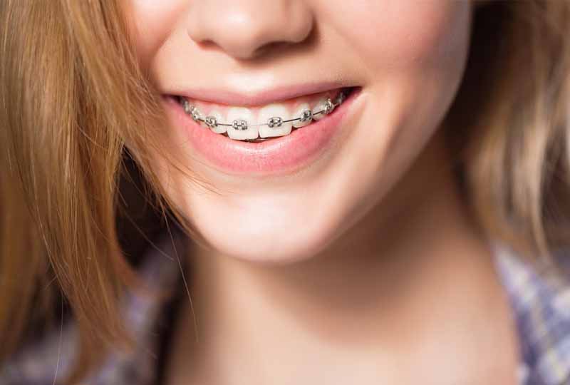 Niềng răng mắc cài kim loại là phương pháp chỉnh nha được sử dụng phổ biến nhất hiện nay