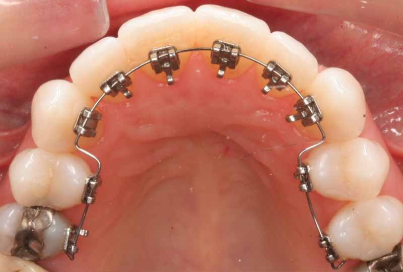 Niềng răng mặt lưỡi - Giải pháp chỉnh nha có tính thẩm mỹ cao