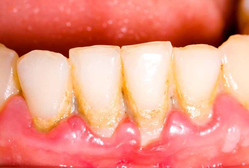 Mảng bám cao răng nhiều cũng khiến lợi bị tụt