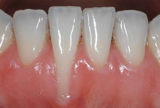 Niềng răng bị tụt lợi là tình trạng phổ biến khi chỉnh nha