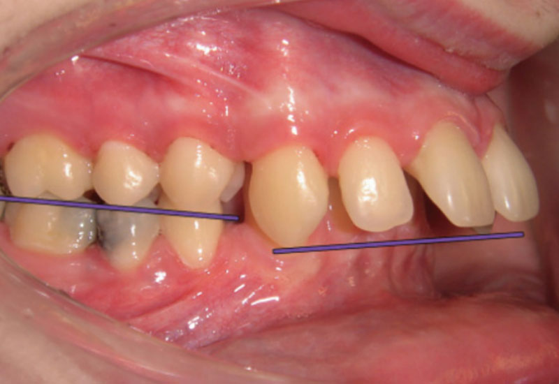 Hình ảnh răng bị hô hàm