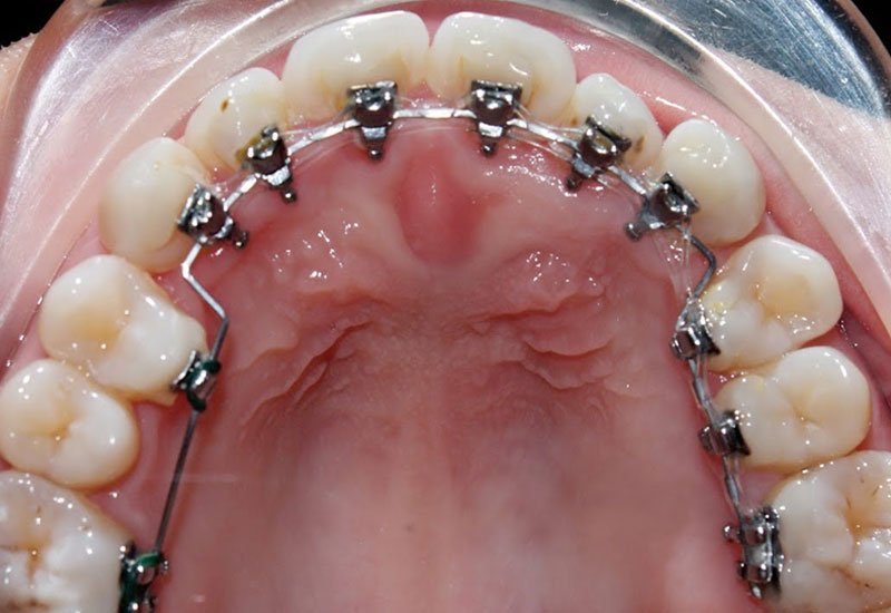 Khi mới gắn mắc cài sẽ xảy ra tình trạng răng bị ê buốt nhẹ