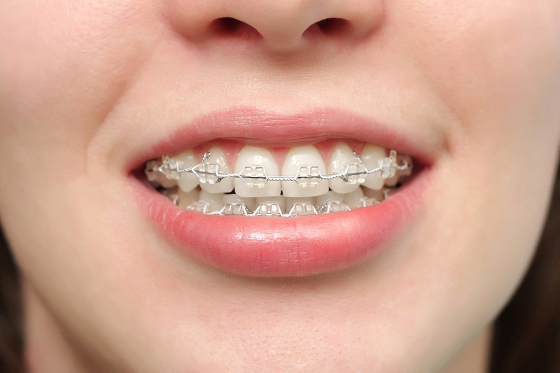 Niềng răng cài sứ giúp bạn tự tin hơn khi giao tiếp