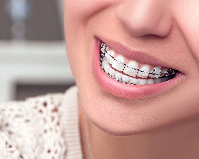 Chi phí cho việc niềng răng cài sứ tương đối cao so với niềng răng mắc cài kim loại thông thường