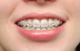 Chi phí niềng răng hàm móm phụ thuộc vào nhiều yếu tố khác nhau