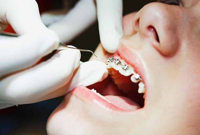 Tái khám răng định kỳ theo đúng lịch hẹn của bác sĩ