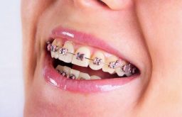 Niềng răng sắt là phương pháp gì? Thời gian và chi phí thực hiện