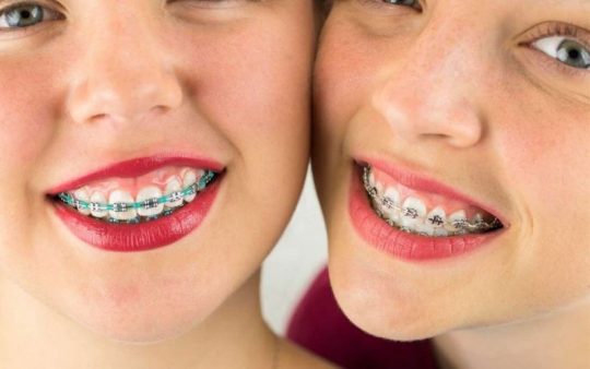 Niềng răng xong vẫn xấu có thể là do các chỉ định của bác sĩ không phù hợp với tình trạng răng của bạn