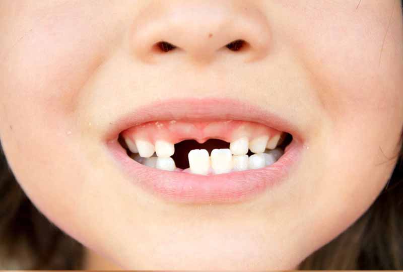Răng bị sâu nặng có thể khiến răng bị lung lay, gãy rụng
