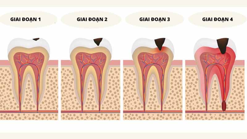 Dấu hiệu khi răng bị sâu trong từng giai đoạn