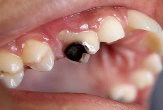 Sâu răng là bệnh lý có thể gặp ở bất kỳ độ tuổi nào