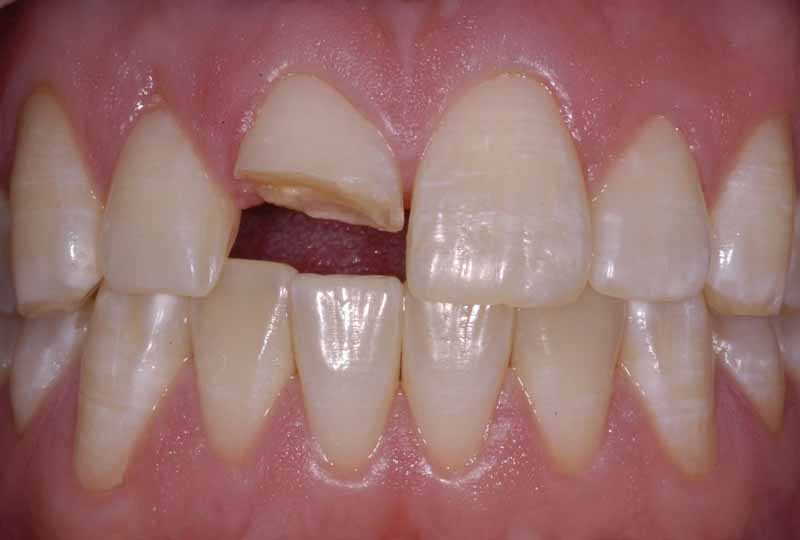 Những răng đã bị nứt vỡ thường dễ chịu tác động bởi vi khuẩn