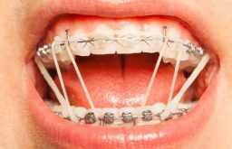 Thun niềng răng là gì? Phân loại, cách sử dụng và lưu ý quan trọng