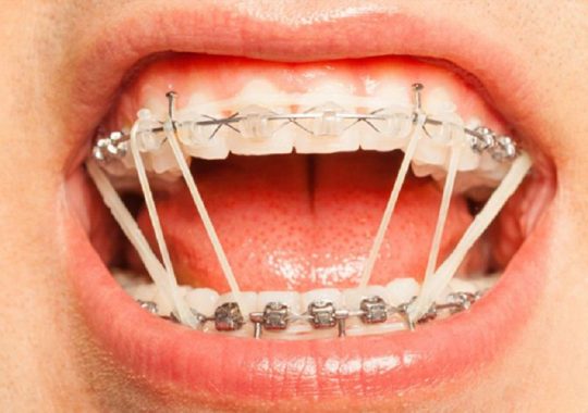 Thun niềng răng là gì? Phân loại, cách sử dụng và lưu ý quan trọng
