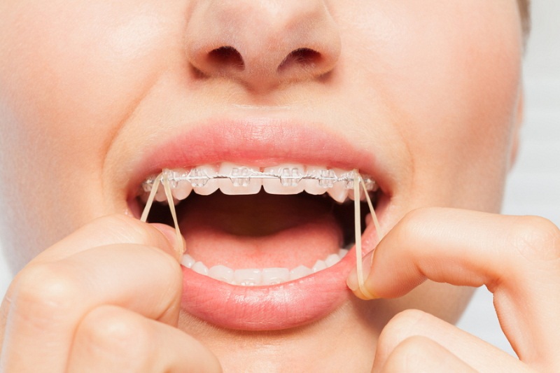 Dây thun niềng răng là một dụng cụ quan trọng được sử dụng để điều chỉnh lại vị trí của 2 hàm