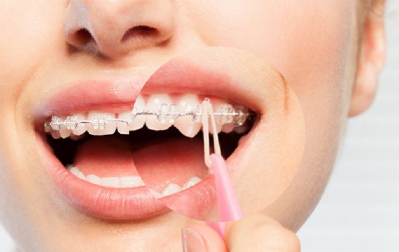 Các loại thun niềng răng này thường được làm bằng chất liệu cao su y tế cao cấp nên lành tính và an toàn cho sức khỏe