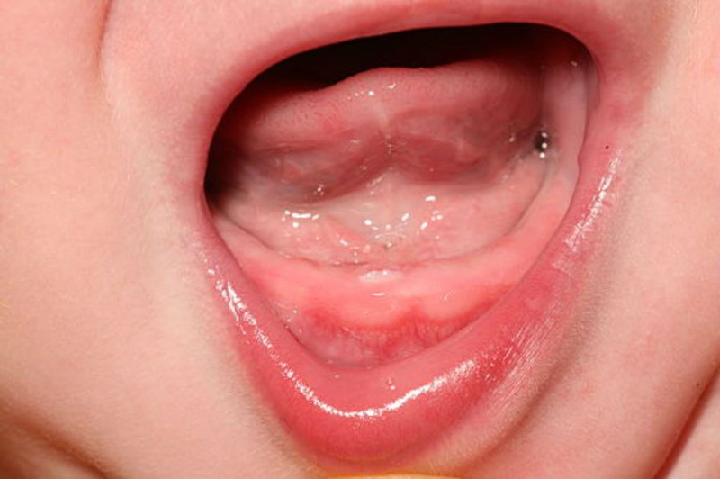 Trẻ chậm mọc răng là tình trạng phổ biến bố mẹ không nên quá lo lắng