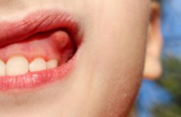 Áp xe nướu răng có thể khiến người bệnh gặp khó khăn trong ăn uống và sinh hoạt