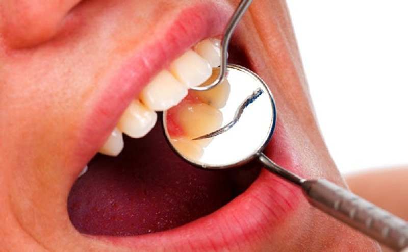 Vệ sinh răng miệng và thăm khám nha khoa định kì để phát hiện và ngăn ngừa áp xe răng.