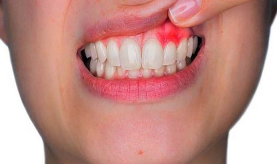 Áp xe răng có nguy hiểm không? Những thông tin cơ bản