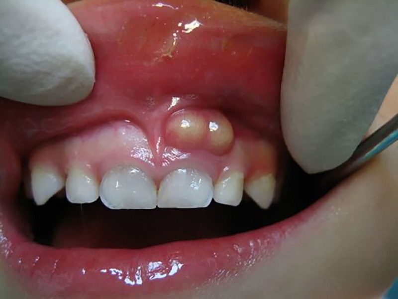 Áp xe răng ở trẻ em được hiểu là tình trạng viêm nhiễm tại vị trí chân răng hoặc giữa răng và lợi