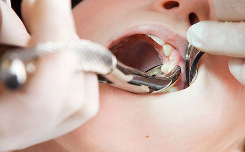 Để điều trị áp xe răng, bệnh nhân cần tới cơ sở nha khoa uy tín để được thăm khám