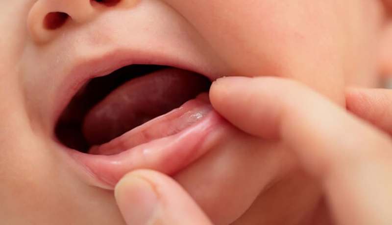 Liệu bé 8 tháng chưa mọc răng có sao không? Nguyên nhân là do đâu?