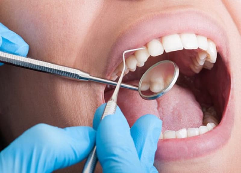 Việc lấy cao răng là hết sức cần thiết nhằm đảm bảo có một hàm răng chắc khỏe và phòng ngừa các vấn đề về sức khỏe răng miệng