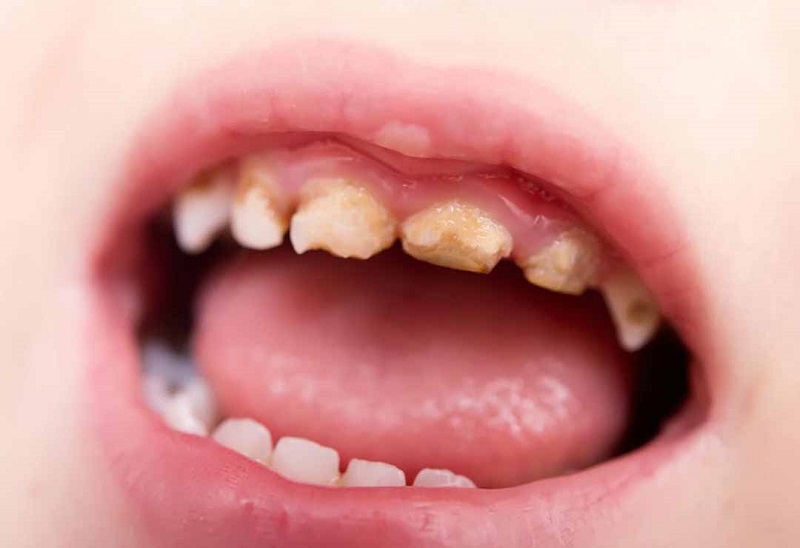 Sâu răng ở trẻ em không chỉ ảnh hưởng đến thẩm mỹ mà còn gây tổn thương tủy răng.