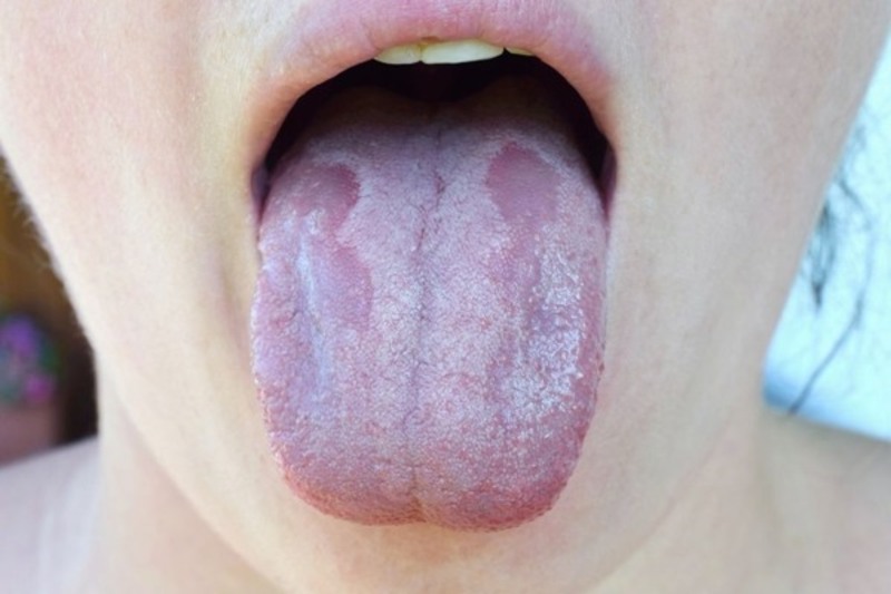 Có rất nhiều nguyên nhân gây ra nấm miệng