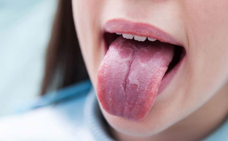 Biến chứng của nấm miệng gây ra ảnh hưởng lớn đến sức khỏe răng miệng
