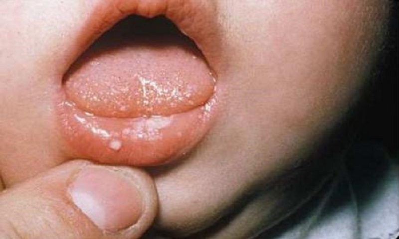 Triệu chứng nhận biết trẻ bị nấm miệng
