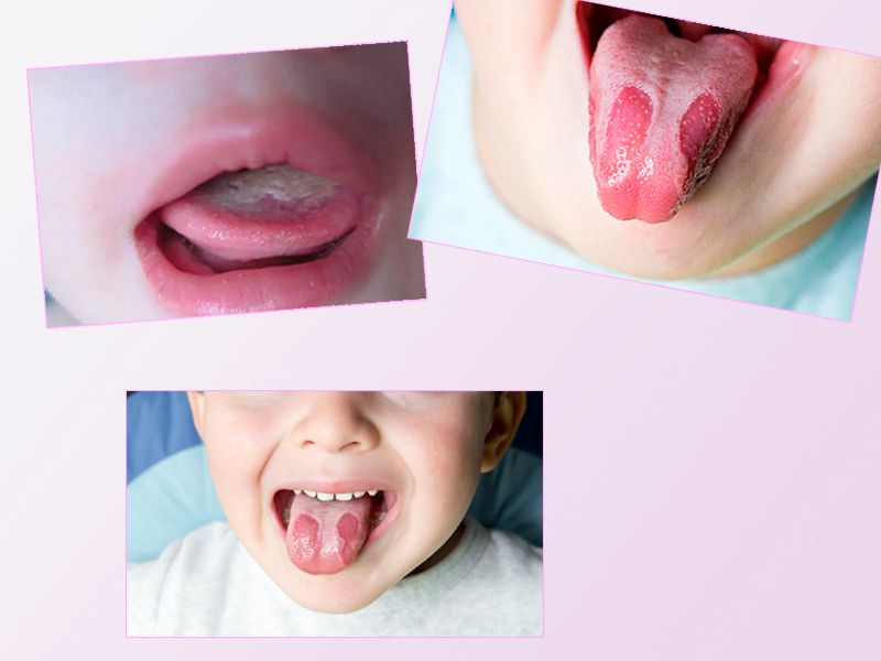 Nguyên nhân gây nấm miệng ở trẻ