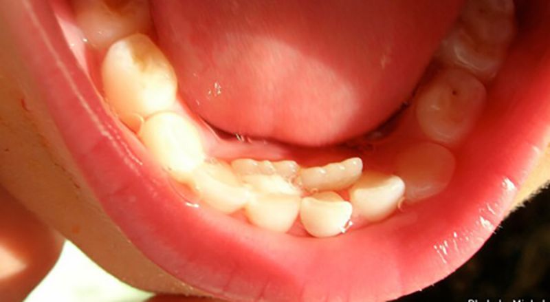 Cha mẹ cần nhổ bỏ răng sữa cho con khi răng vĩnh viên mọc vào trong trồng nên răng sữa.