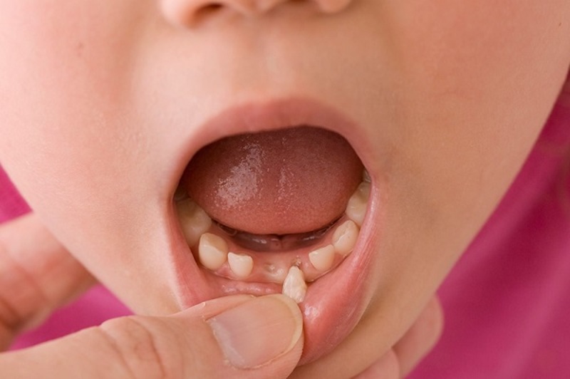 chân răng sữa còn sót lại cũng là một mối lo ngại tiềm ẩn gây ra nguy cơ cho trẻ dễ bị viêm nha chu