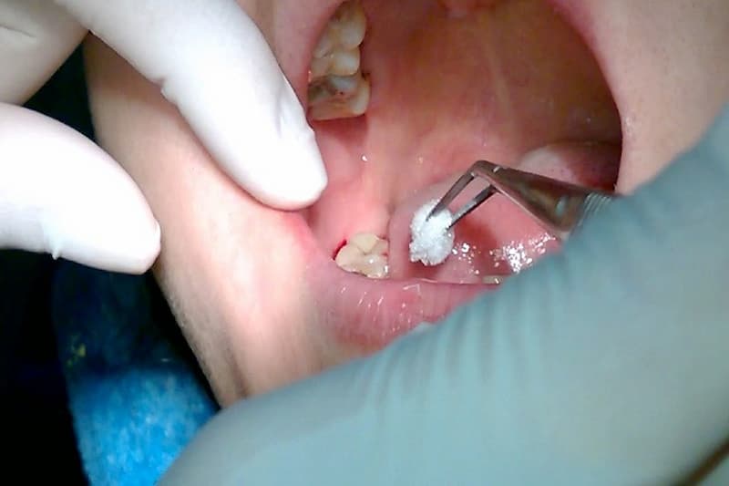 Nhổ răng khôn là một trong những cách trị viêm lợi trùm dứt điểm