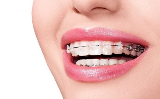 Niềng răng bao nhiêu tuổi là thích hợp nhất?