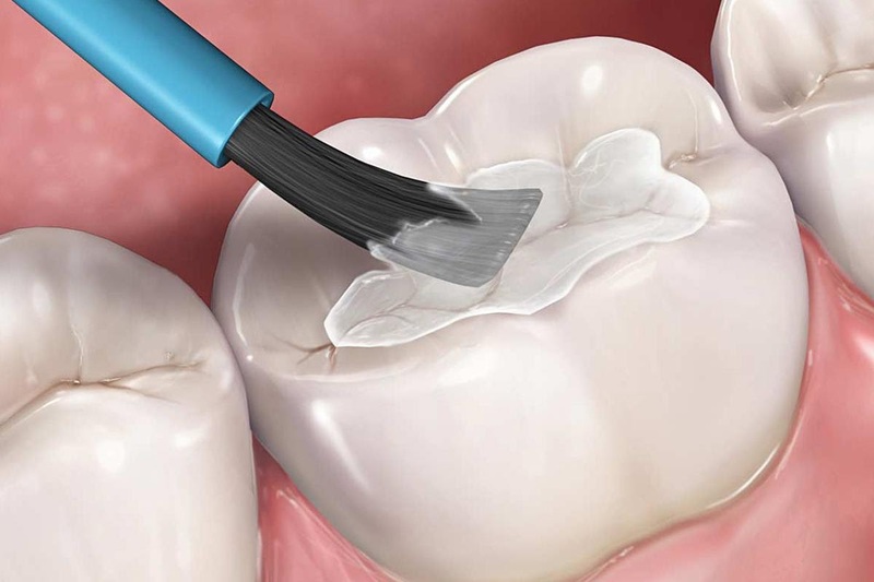 ể ngăn chặn tình trạng sâu răng phát triển, bạn cần theo dõi và chăm sóc răng miệng