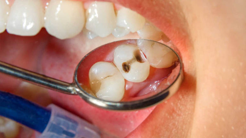 Viêm quanh cuống răng cũng là nguyên nhân gây sâu răng