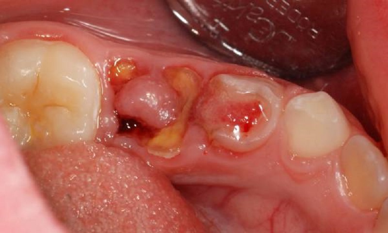 Răng sâu bị lồi thịt là hiện tượng răng đang ở mức độ cấp tính