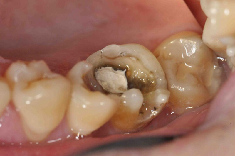 Đây là bệnh lý sâu răng ở giai đoạn vi khuẩn có hại đã xâm nhập qua lớp ngà sâu của răng