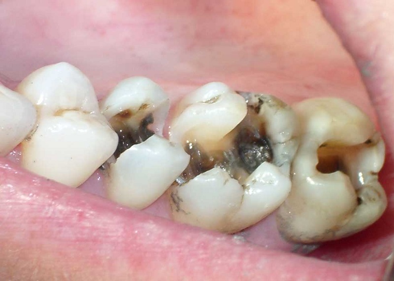 Trường hợp sâu rặng nặng cần phải điều trị tủy và bọc răng sứ