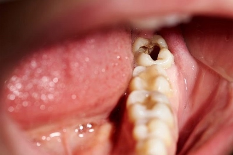 Vi khuẩn có trong vôi răng sẽ tiến hành quá trình phá hủy và gây hư hại lên bề mặt của men răng